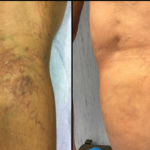 Clinical photograph of reticular veins and thread veins after treatment