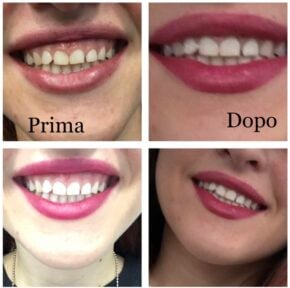 “Gummy Smile”,即露龈笑,指微笑时露出过多牙龈的情况。其原因可能不同,但常与上唇抬高过度有关。