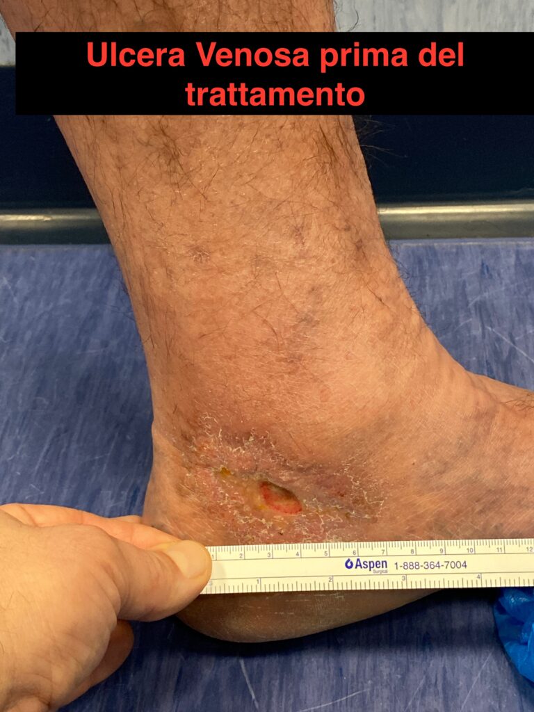 Venous ulcer before an integrated treatment programme