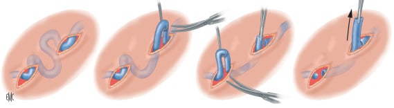 Ambulatory phlebectomy in Naples for selected superficial varicose veins