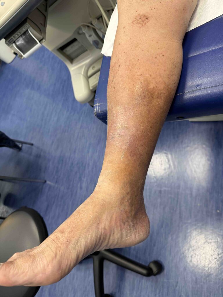 Progress of a venous ulcer after treatment and follow-up