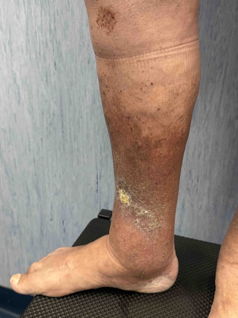 Venous leg ulcer before treatment