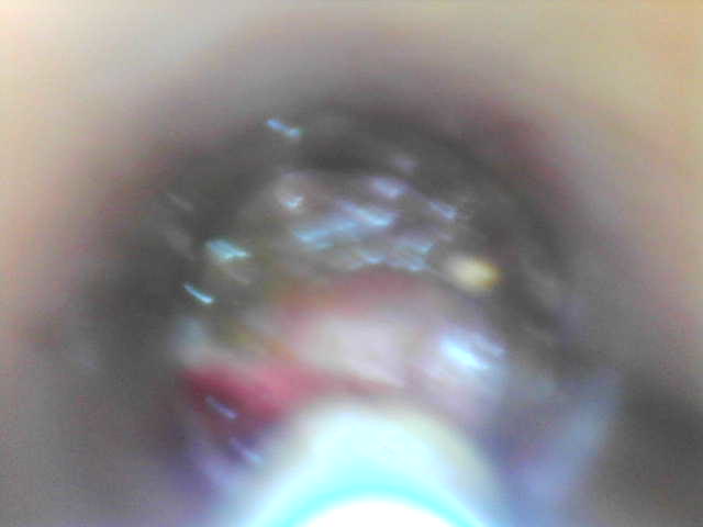 Scleroterapia emorroidi – trattamento ambulatoriale a Napoli