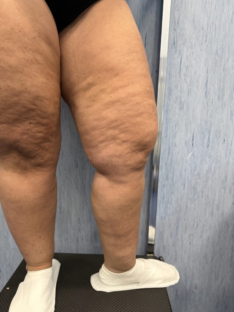 Swollen and heavy legs: clinical assessment and venous colour Doppler ultrasound when indicated