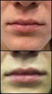 Hyaluronic acid fillers in Naples: natural-looking lip result