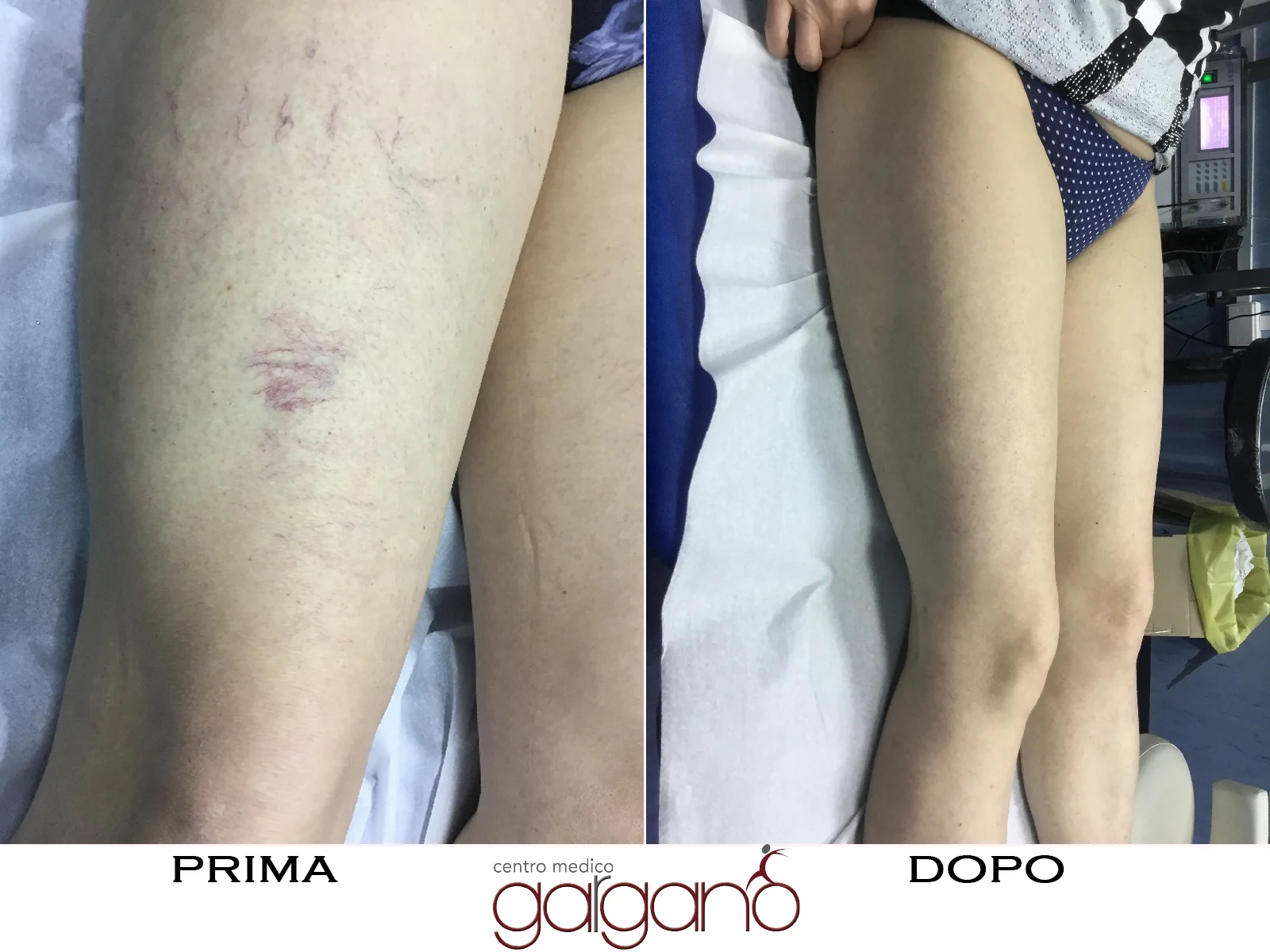 Confronto dei capillari delle cosce in due fotografie: prima a sinistra e dopo a destra