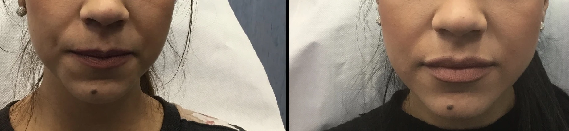 Two side-by-side photographs of the lips relating to a lip filler treatment