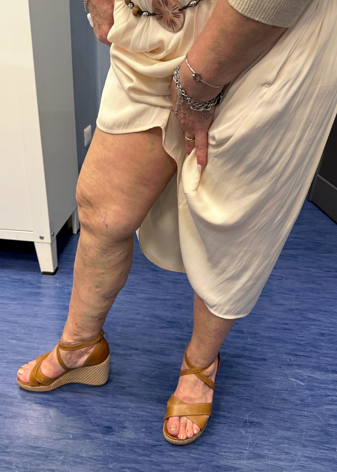 Gambe in posizione eretta, con una gamba esposta dalla coscia alla caviglia, a un mese dal trattamento.