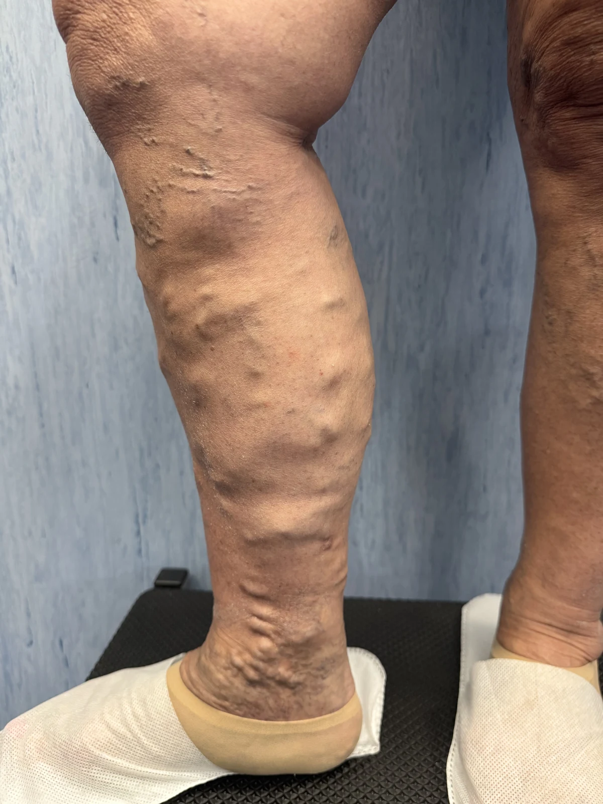 Dettaglio della gamba dal ginocchio alla caviglia con vene superficiali in rilievo, prima del trattamento.