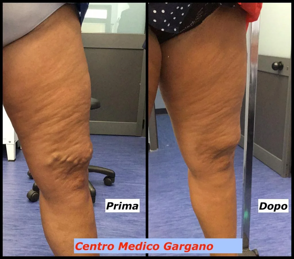 Confronto della coscia e del ginocchio, prima a sinistra e dopo scleroterapia con schiuma a destra.