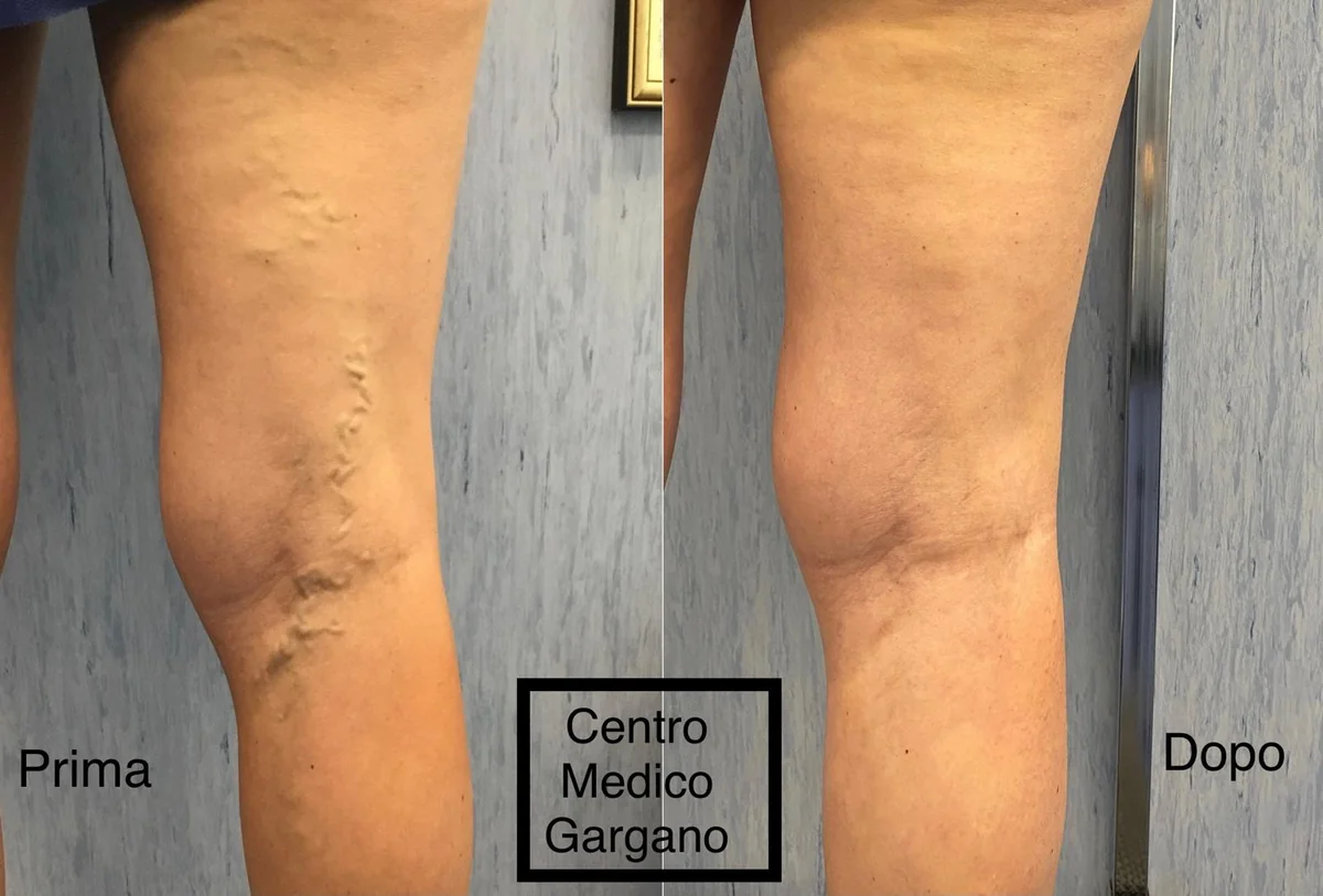 Dettaglio della gamba nella zona del ginocchio, prima a sinistra e dopo scleroterapia con schiuma a destra.