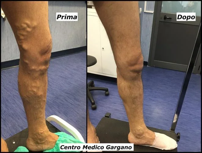 Confronto laterale della gamba, prima a sinistra e dopo scleroterapia con schiuma a destra.