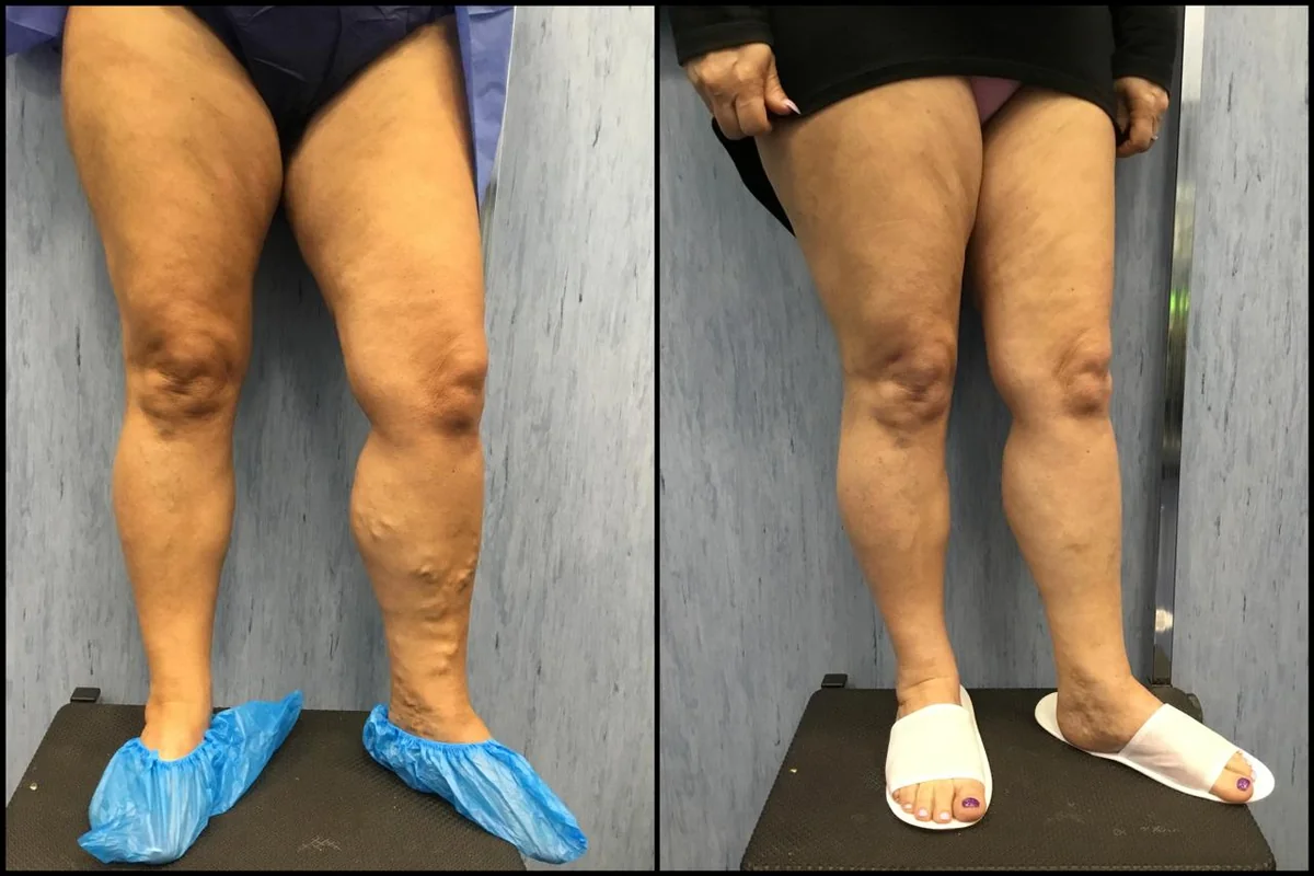 Confronto delle gambe viste frontalmente, prima a sinistra e dopo scleroterapia con schiuma a destra.