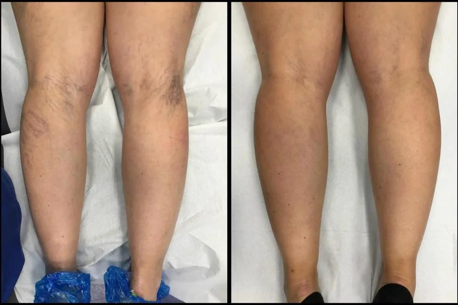 Confronto delle gambe viste da dietro, prima a sinistra e dopo scleroterapia con schiuma a destra.